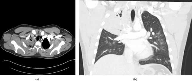 Severe Pulmonary Blastomycosis in a Young Adult: Probable Role of E-Cigarette Use in Immunosuppression.