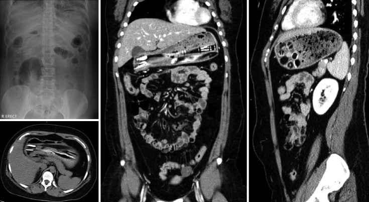 Endoscopic Removal of Multiple Toothbrushes: A Case Report.
