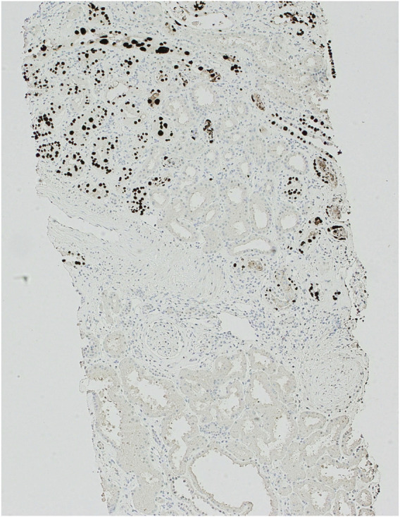 JC Polyomavirus-Associated Nephropathy Case Report: Clinical and Laboratory Learning.