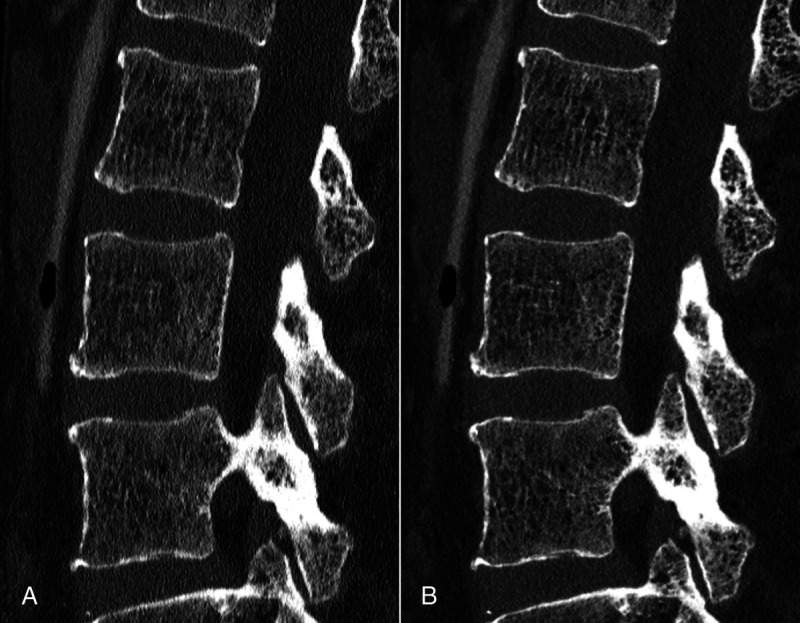 Photon-Counting Detector CT Applications in Musculoskeletal Radiology.