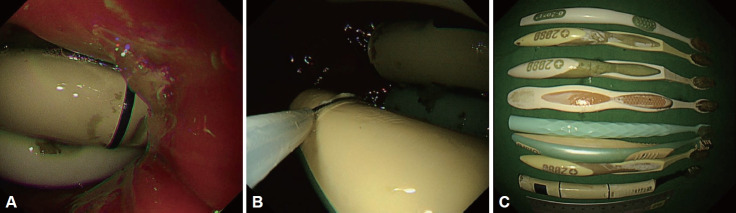 Endoscopic Removal of Multiple Toothbrushes: A Case Report.
