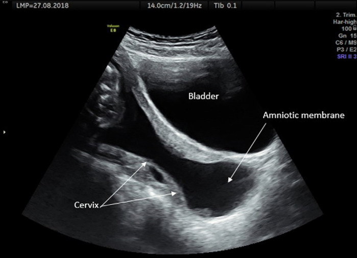 Outcomes of emergency cervical cerclage after amnioreduction in twin pregnancies with a fully dilated cervix and amniotic membrane prolapse.