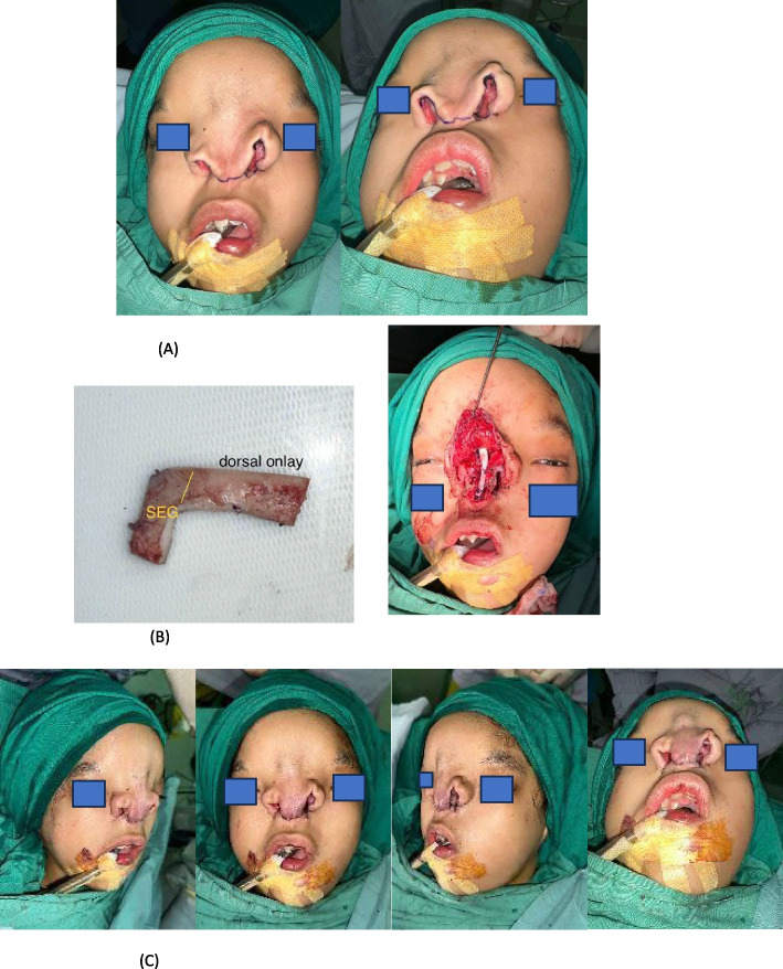 Challenges in nasal reconstruction for facial clefts Tessier 3 bilateral and Tessier 0: a staged surgical approach case report.