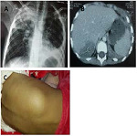 Clinical manifestations of 42 Moroccan patients with chronic granulomatous disease.