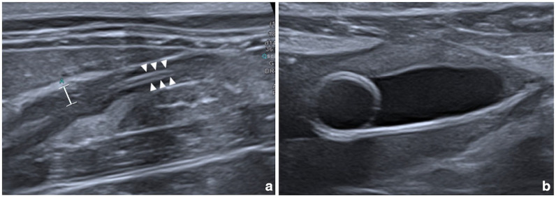 Struvite ureterolithiasis associated with ureolytic bacterial pyelonephritis in a cat.