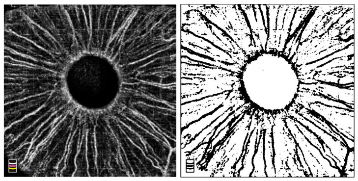 Iris Microcirculation After Selective Laser Trabeculoplasty: A Pilot Optical Coherence Tomography Angiography Study.