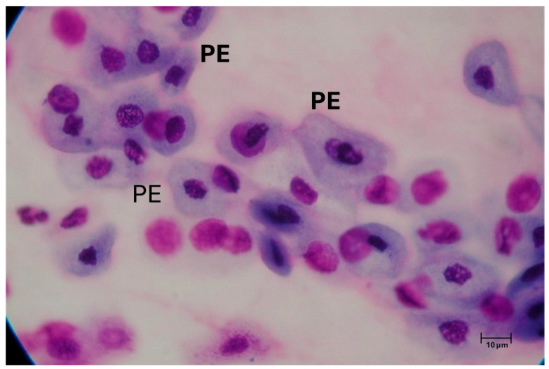 Rhinitis in the Geriatric Population: Epidemiological and Cytological Aspects.