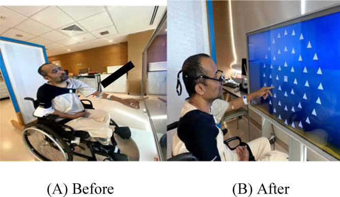 Innovative rehabilitation intervention in a young stroke patient with Parinaud syndrome: A case report.