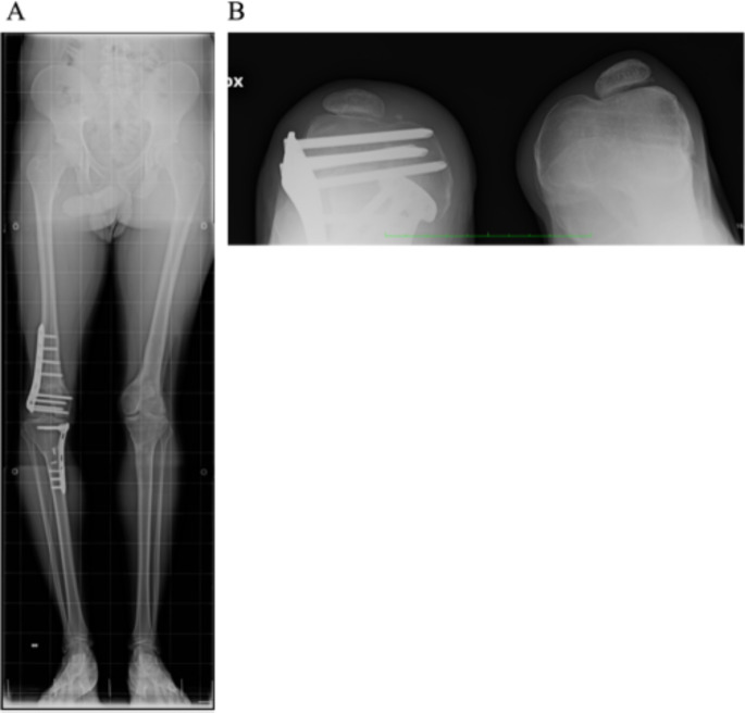 A novel frameshift TBX4 variant in a family with ischio-coxo-podo-patellar syndrome and variable severity.