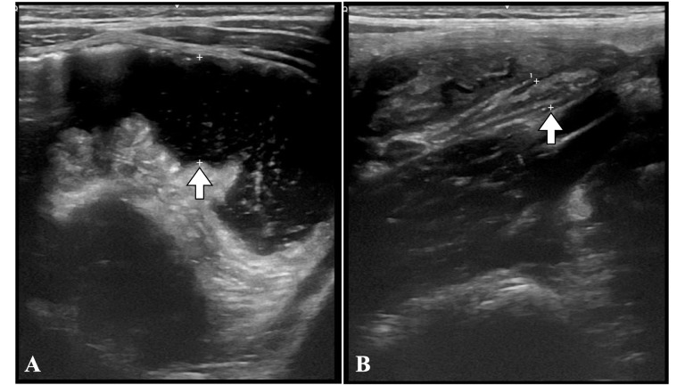 [Abdominal pain and inconclusive ultrasound: a CT scan may not always be the best next step]