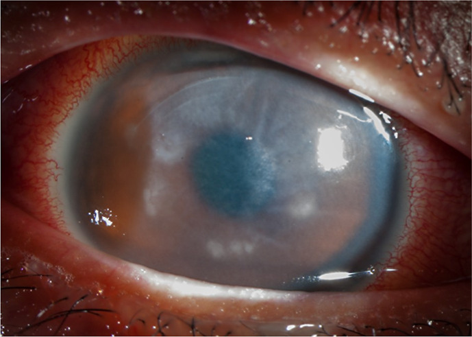 <i>Mycobacterium chelonae</i> Keratitis following Keratorefractive Lenticule Extraction: Highlighting Diagnostic and Treatment Complexities.