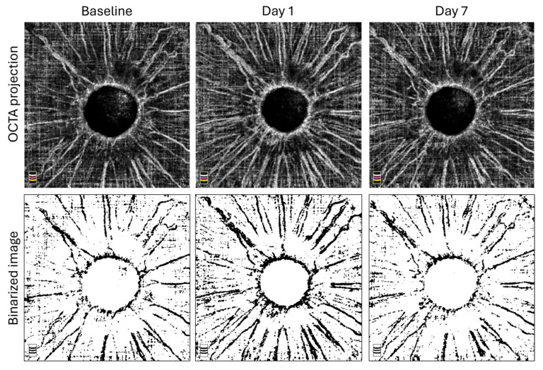 Iris Microcirculation After Selective Laser Trabeculoplasty: A Pilot Optical Coherence Tomography Angiography Study.
