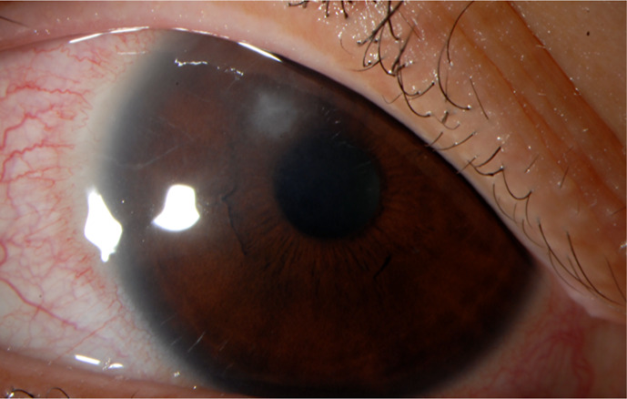 <i>Mycobacterium chelonae</i> Keratitis following Keratorefractive Lenticule Extraction: Highlighting Diagnostic and Treatment Complexities.