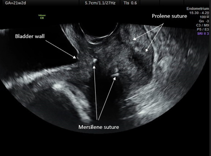Outcomes of emergency cervical cerclage after amnioreduction in twin pregnancies with a fully dilated cervix and amniotic membrane prolapse.
