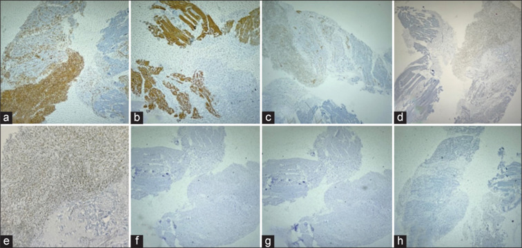A Case Report of Metastatic Primary Thyroid Sarcoma Evaluated by <sup>18</sup>F-FDG PET/CT.