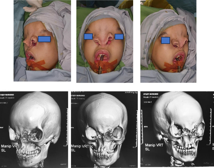 Challenges in nasal reconstruction for facial clefts Tessier 3 bilateral and Tessier 0: a staged surgical approach case report.