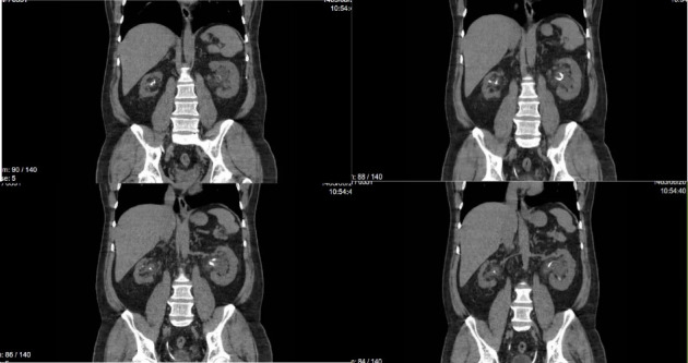 Knotted and Encrusted Double J Stent: A Rare Complication Managed With Advanced Endoscopic Techniques.