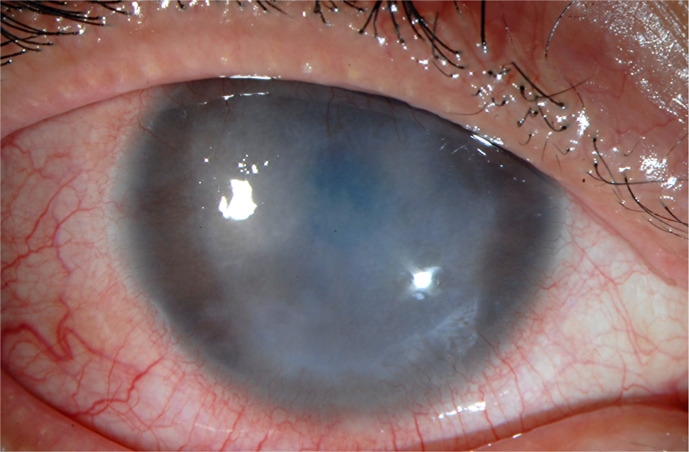 <i>Mycobacterium chelonae</i> Keratitis following Keratorefractive Lenticule Extraction: Highlighting Diagnostic and Treatment Complexities.