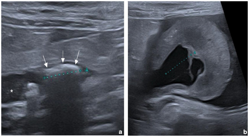 Struvite ureterolithiasis associated with ureolytic bacterial pyelonephritis in a cat.
