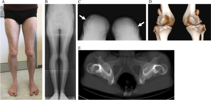 A novel frameshift TBX4 variant in a family with ischio-coxo-podo-patellar syndrome and variable severity.