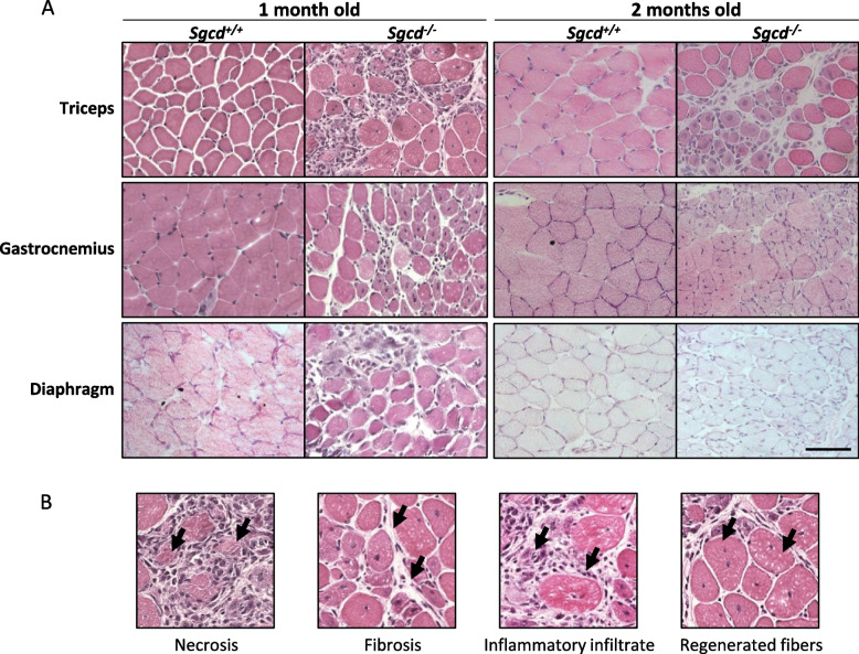 Dysregulated ATX-LPA and YAP/TAZ signaling in dystrophic Sgcd<sup>-/-</sup> mice with early fibrosis and inflammation.