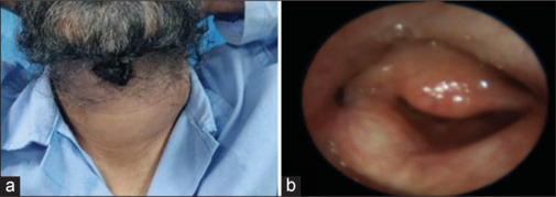 A Case Report of Metastatic Primary Thyroid Sarcoma Evaluated by <sup>18</sup>F-FDG PET/CT.