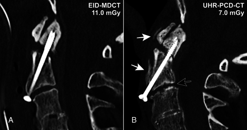 Photon-Counting Detector CT Applications in Musculoskeletal Radiology.