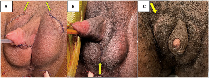 Testicular Implant Complications after Transmasculine Gender Affirming Surgery.
