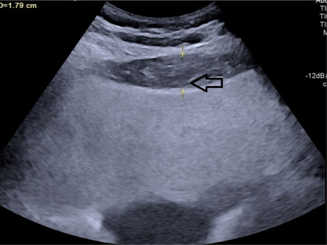 Ultrasonography-based prediction of carotid artery atherosclerosis using multiple abdominal fat indices.