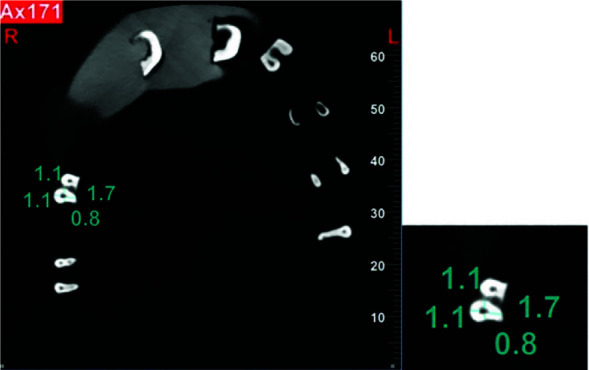 Comparison of Hand Files, Mtwo, Reciproc, and Gentlefile Rotary Systems Regarding Canal Transportation, Centering Ability, and Obturation Quality of Primary Molars.