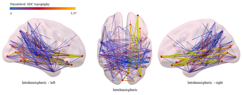 Linking Memory Impairment to Structural Connectivity in Extrahippocampal Temporal Lobe Epilepsy Surgery.