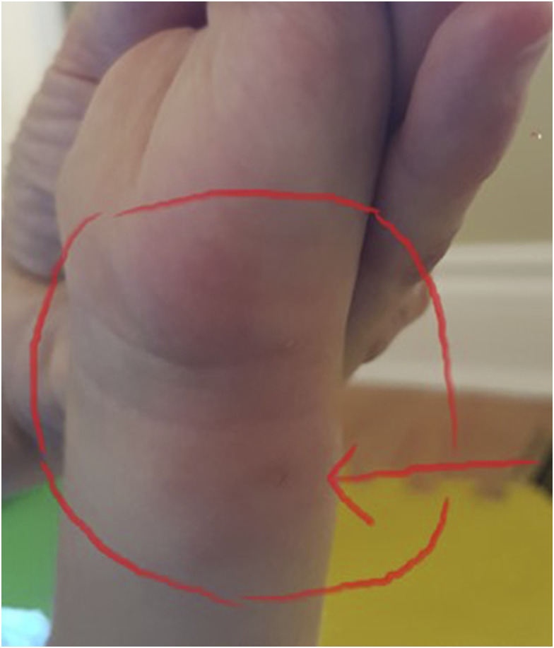 <i>Bartonella henselae</i>, <i>Babesia odocoilei</i> and <i>Babesia divergens</i>-like MO-1 infection in the brain of a child with seizures, mycotoxin exposure and suspected Rasmussen's encephalitis.