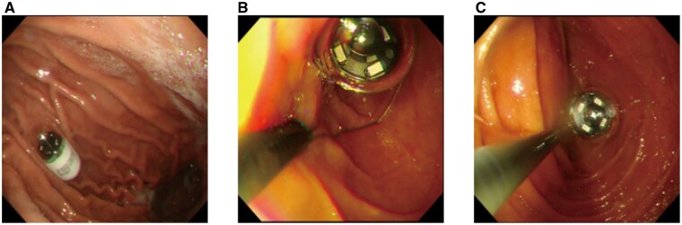 Latest possible timing for endoscopic-assisted intervention in capsule endoscopy.