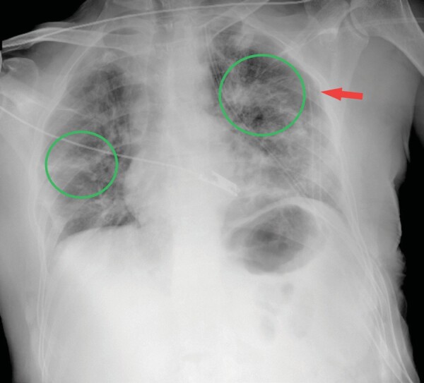 Birt-Hogg-Dubé syndrome: A case series highlighting pulmonary manifestations, rare renal involvement and role of familial diagnosis.