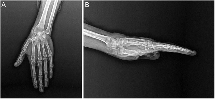 A rare case of an isolated scaphoid dislocation neglected for 45 years: A case report and literature review.