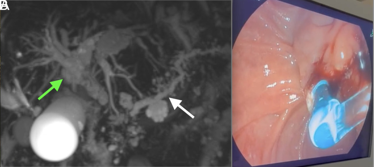 White Bile Detected During Endoscopic Retrograde Cholangiopancreatography: A Rare Phenomenon and Its Clinical Implications.