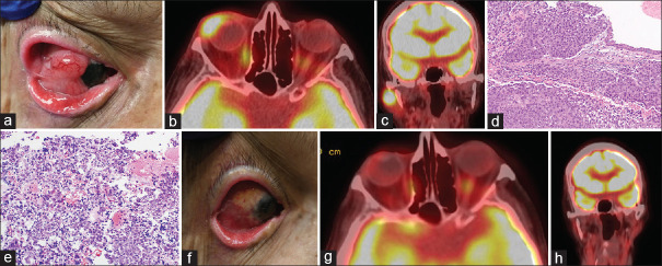 Immune check point inhibitors for ocular adnexal and periocular tumors.