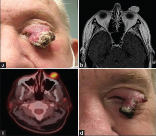 Immune check point inhibitors for ocular adnexal and periocular tumors.
