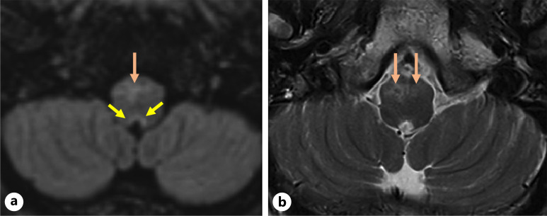Seronegative Autoimmune Encephalomyelitis with Area Postrema Symptoms.