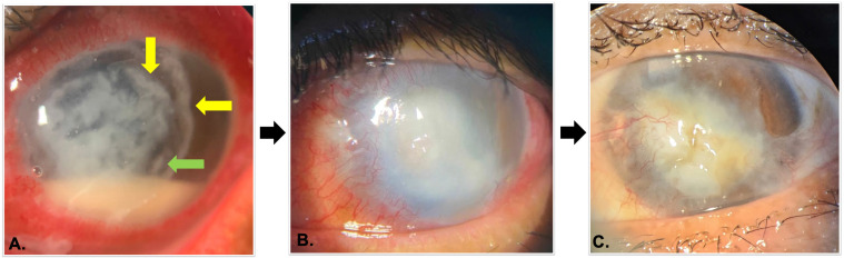 A complex case of Nocardia keratitis: challenges in diagnosis and therapy.