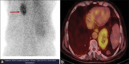 Intrathoracic Kidney Detected on DTPA Scan.