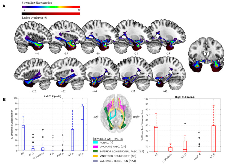 Linking Memory Impairment to Structural Connectivity in Extrahippocampal Temporal Lobe Epilepsy Surgery.