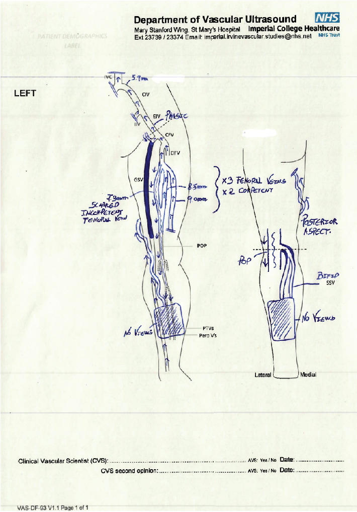 Duplex Ultrasound Scan Can Prevent Leg Amputation in Severe Postthrombotic Syndrome: A Case Report.