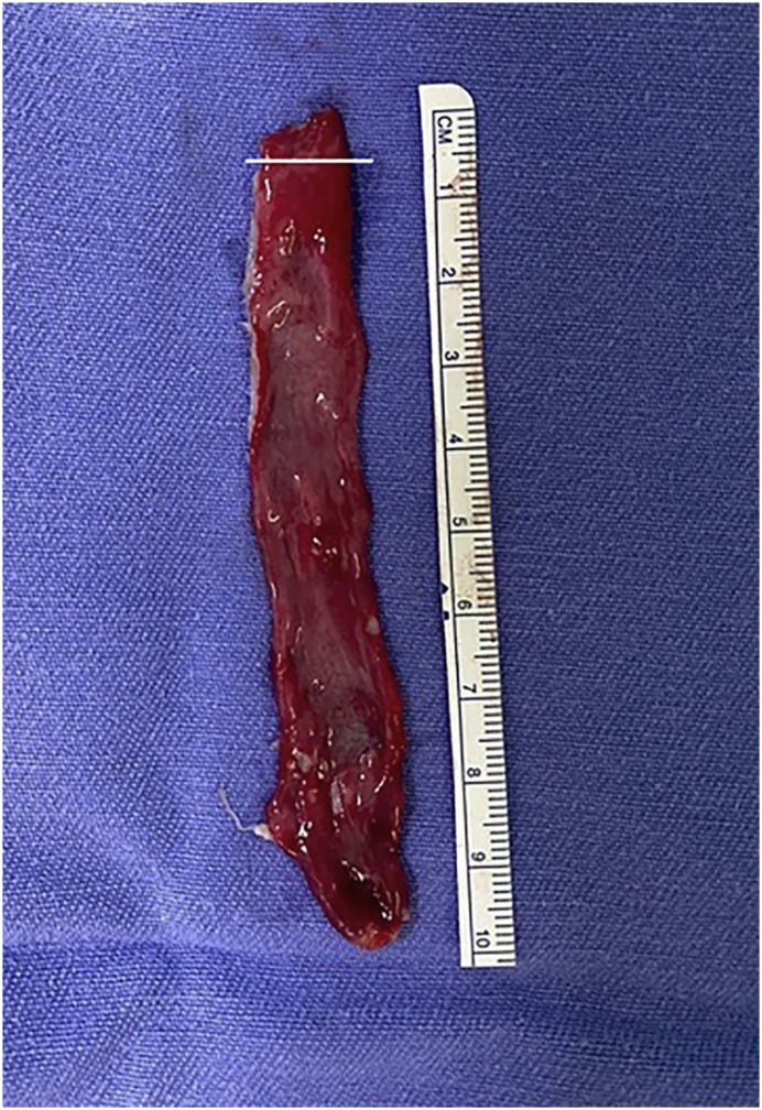 Bladder Mucosa Harvested with Holmium Laser for Treatment of Urethral Strictures: Does the Graft Have its Tissue Integrity Preserved?