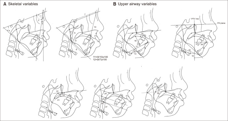 Preliminary study on change in the upper airway dimension in growing patients with Pierre-Robin sequence.