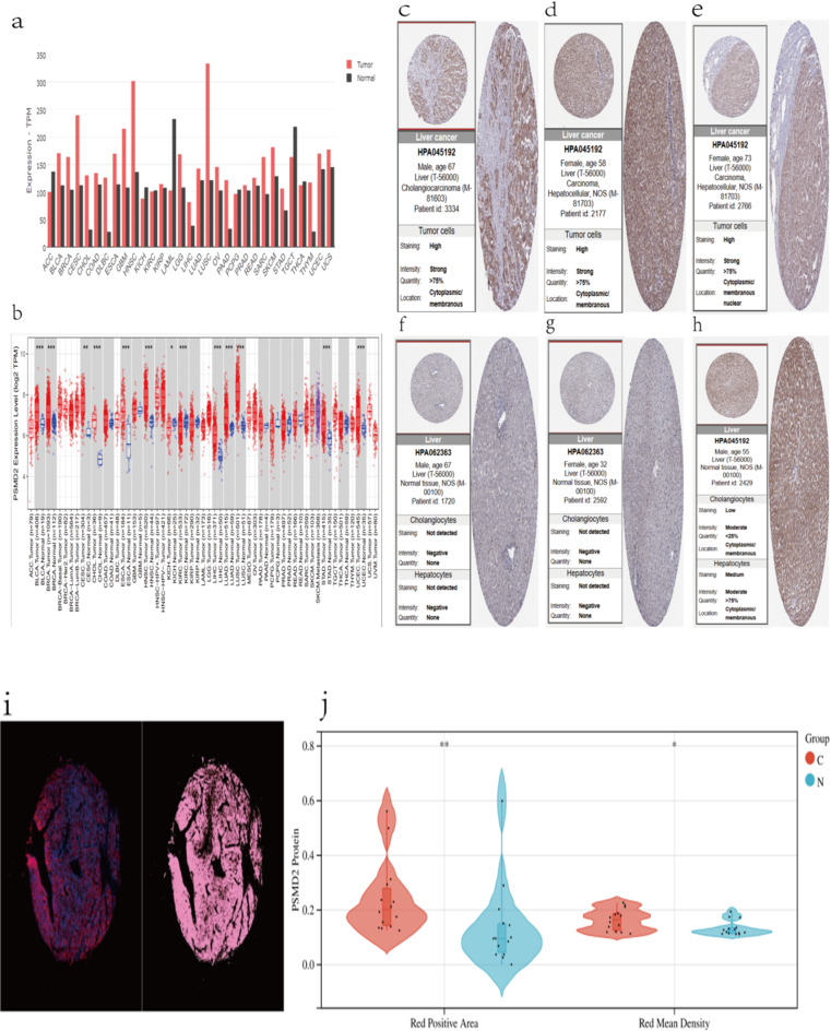Expression of PSMD2 gene in hepatocellular carcinoma and its correlation with immune checkpoints and prognosis.