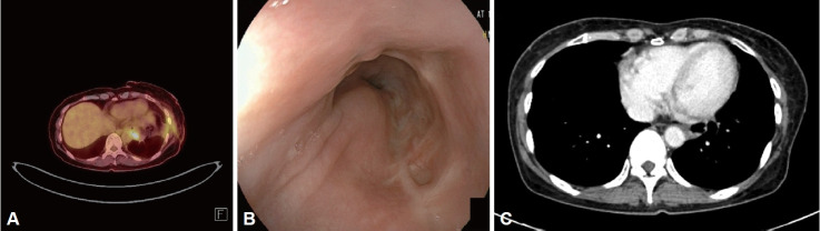 Rapidly Growing Gastrointestinal Stromal Tumor on the Esophagus.