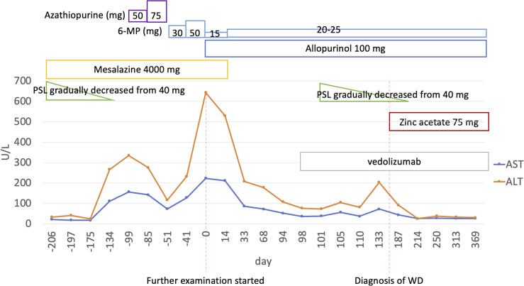 Asymptomatic Wilson's Disease Diagnosed during the Course of Ulcerative Colitis: A Case Report and Review.