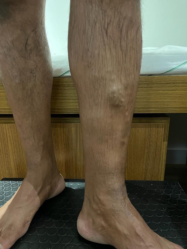 Anomalous intraosseous venous drainage of pretibial varices: case report.
