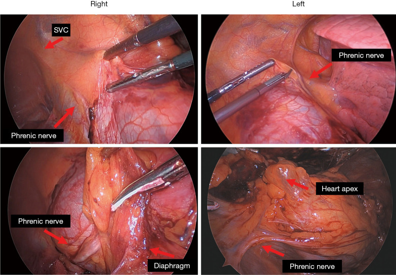 Surgical approaches for thymectomy: a narrative review.